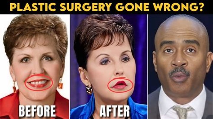 Joyce Meyers' Plastic Surgery Journey: Before And After Transformation