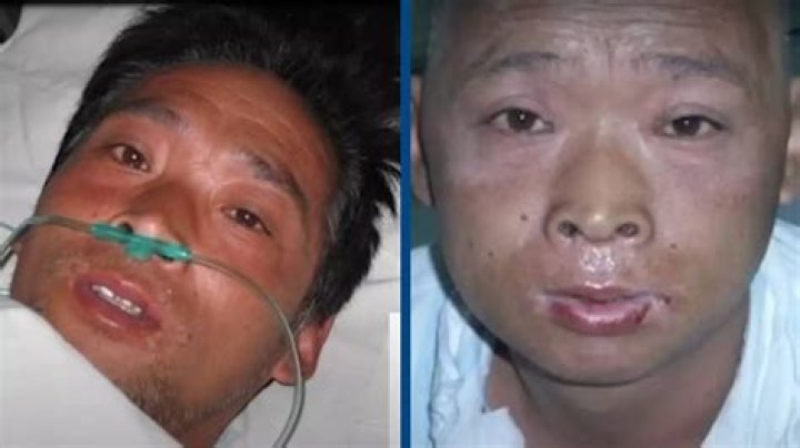 The Devastating Aftermath Of Hisashi Ouchi's Radiation Exposure